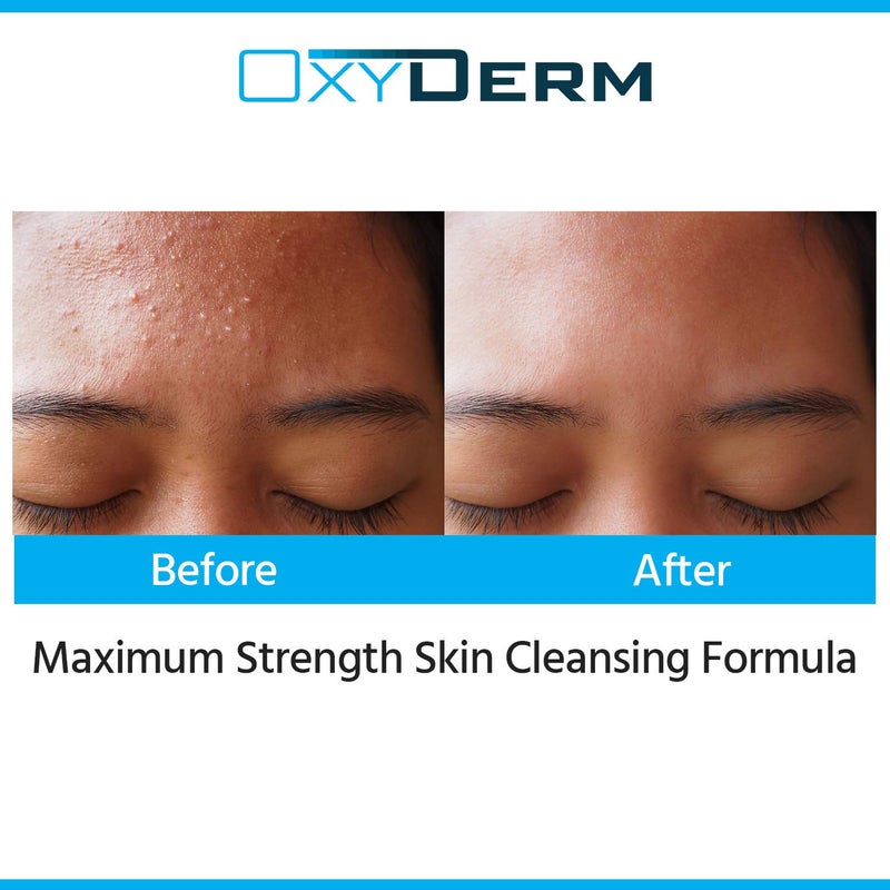OxyDerm Acne Face wash Treatment with Benzoyl Peroxide 5% - Clinically Proven Wash to Fight Acne Blemishes on Contact. Eliminates Cystic Breakouts, Oily Skin, Clogged Pores, Blackhead, Whitehead, & Pimples. - Image 3